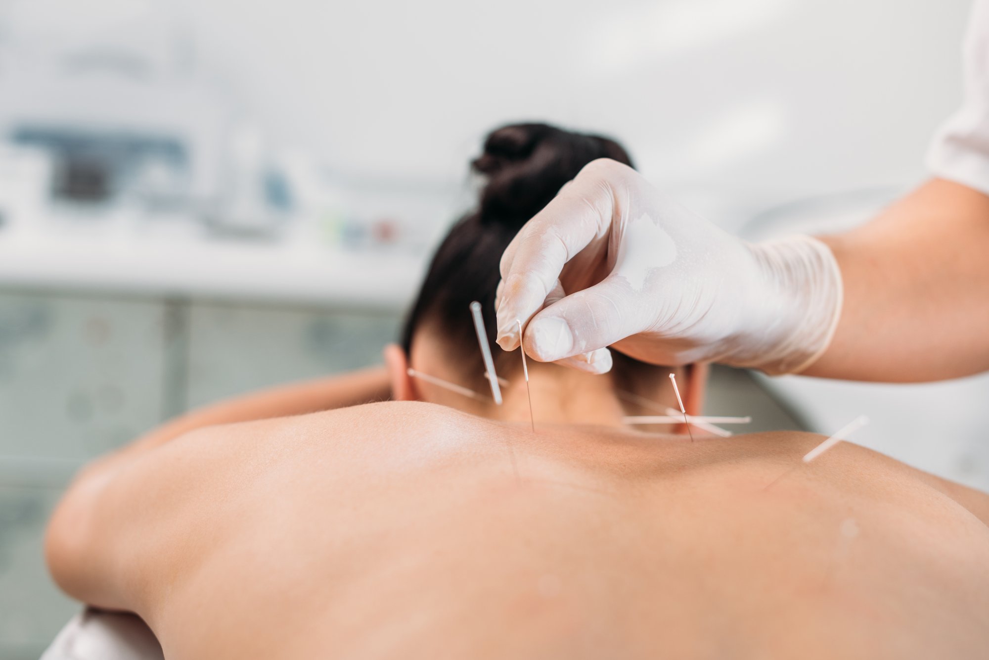 dry-needling-physical-therapy