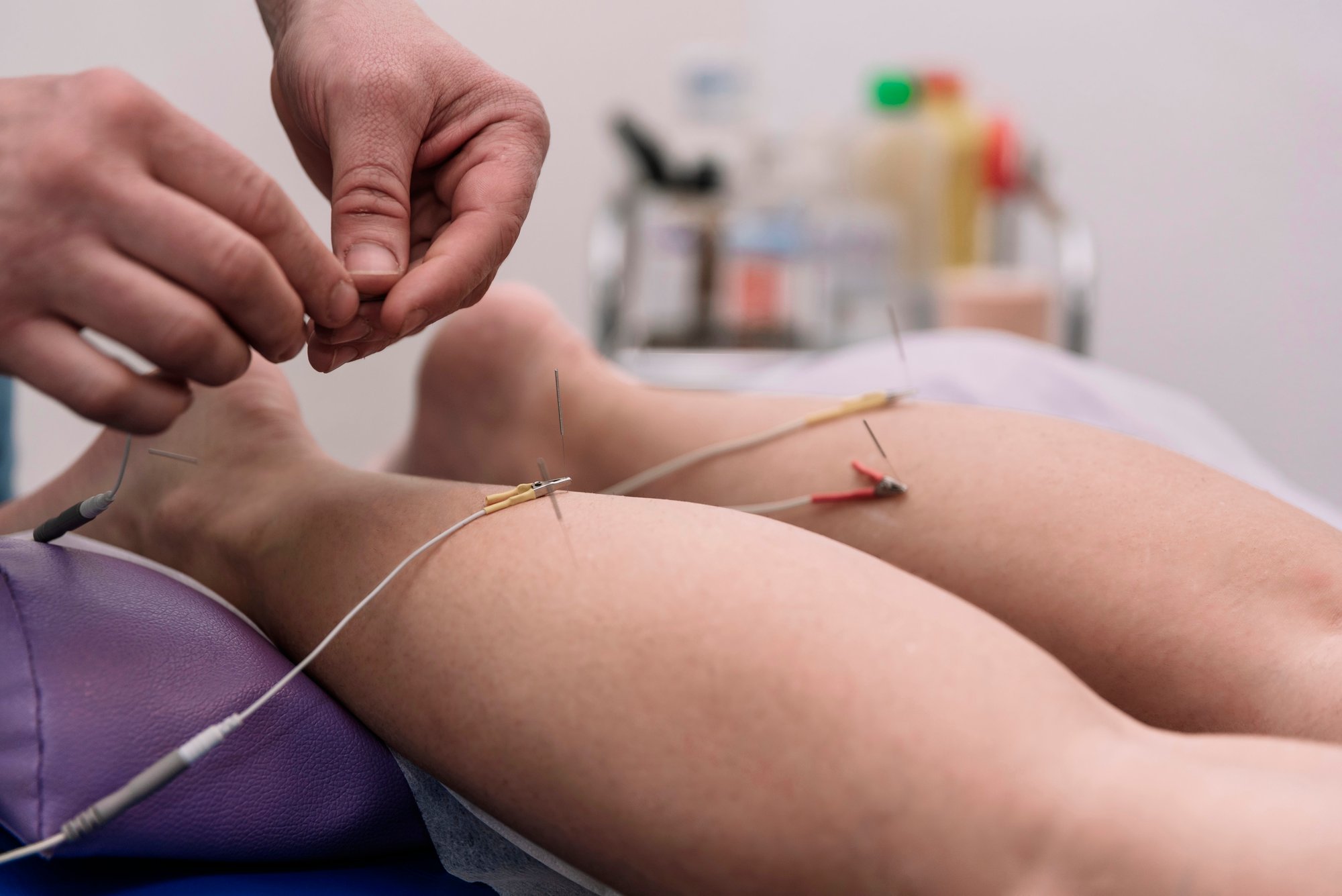 dry-needling-pt