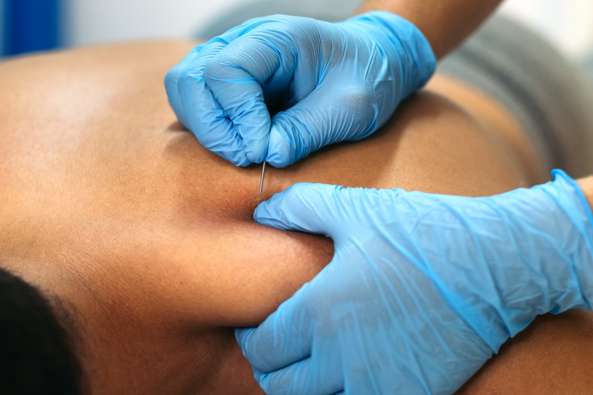 physiotherapy-clinic-dry-needling